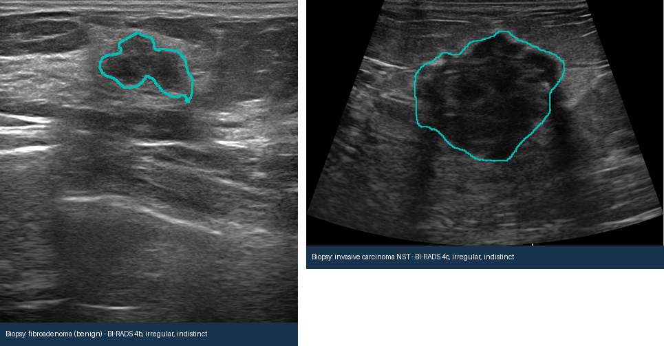 Two similar-looking breast ultrasound lesions, one benign and one malignant, both confirmed by biopsy.